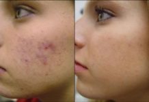 VIDEO: चेहरे से हटाए दाग धब्बे अपनाये ये नुस्खा Remove scars from the face