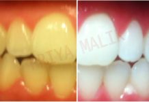 पिले दातों से हैं परेशान तो अपनाए ये घरेलु उपाय, 3 मिनट में हो जाएंगे चमकते सफ़ेद दांत