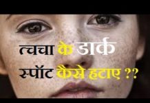 त्चचा के डार्क स्पॉट कैसे हटाए? जाने इस खबर से