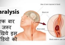 लकवा मारने पर तुरंत करें ये उपाय, पुनः स्वस्थ हो जाएगा मरीज