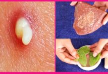 इस तरह कुछ मिनटों में छुटकारा पाएं अपने कील, मुहासों और काले धब्बो से