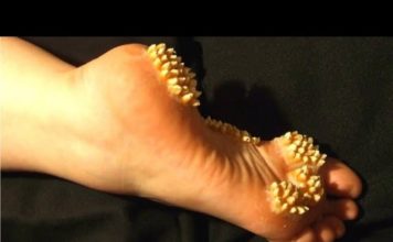 दुनिया की सबसे दुर्लभ और विचित्र बीमारिया || Rare & Strange Diseases in the World